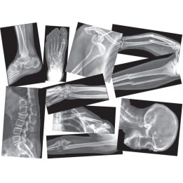 Roylco® Broken Bones X-Ray Set, Pack of 15