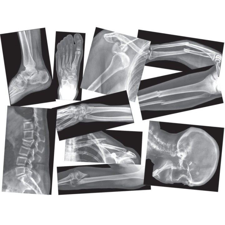 Roylco® Broken Bones X-Ray Set, Pack of 15