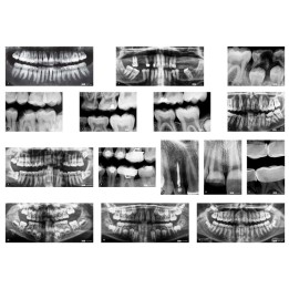 Roylco® Dental X-Rays